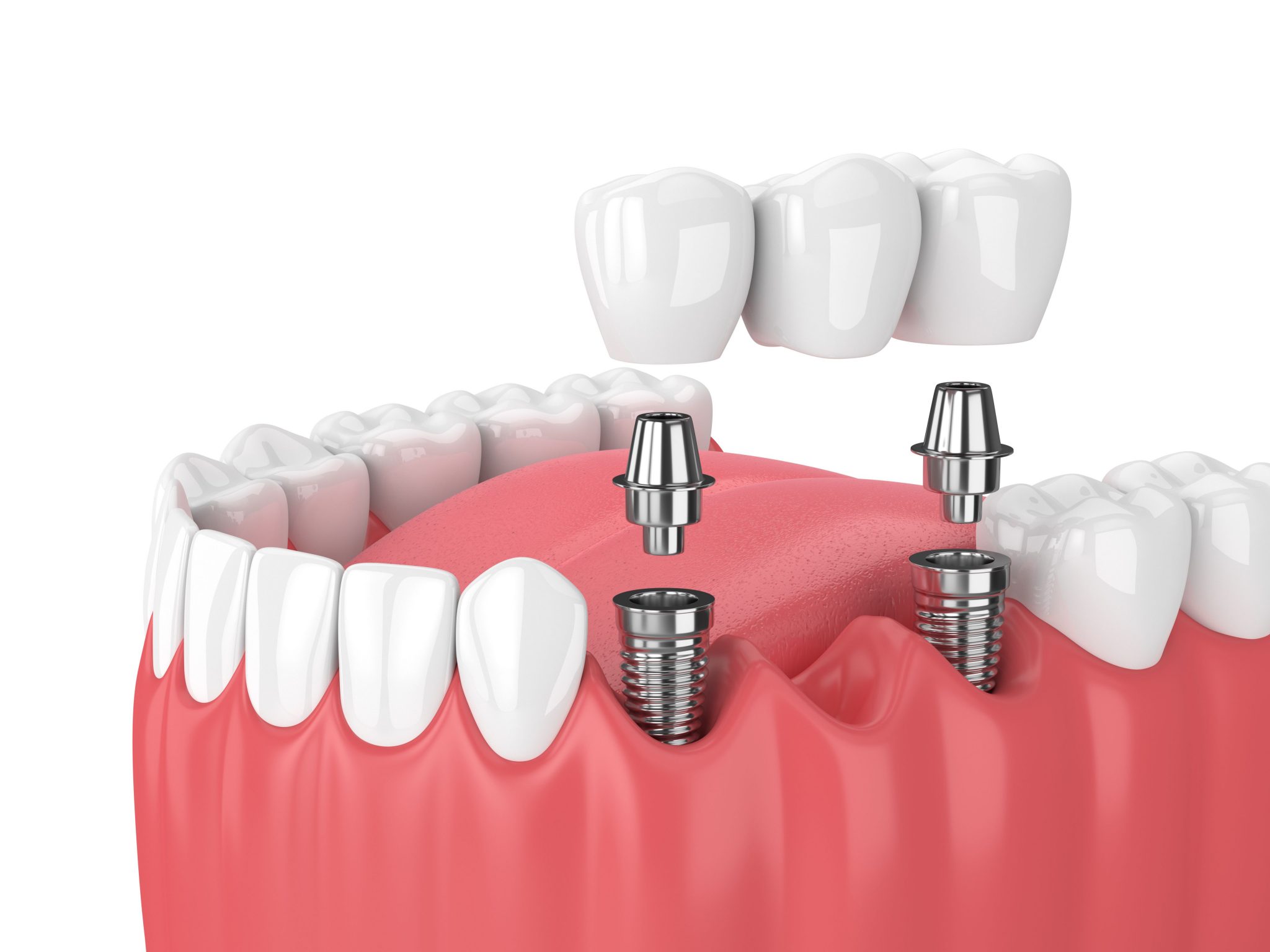 Root Canal Treatment in Gurugram Root Canal Treatment in Gurugram