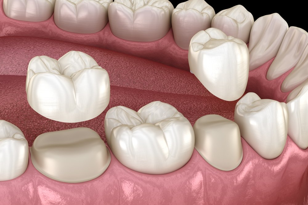 Root Canal Treatment in Gurugram Root Canal Treatment in Gurugram