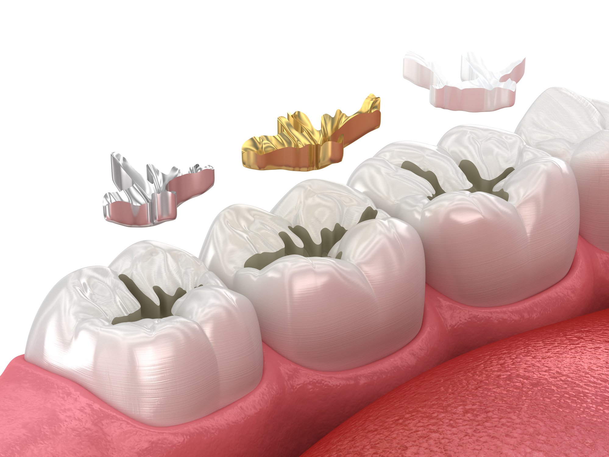 Root Canal Treatment in Gurugram Root Canal Treatment in Gurugram