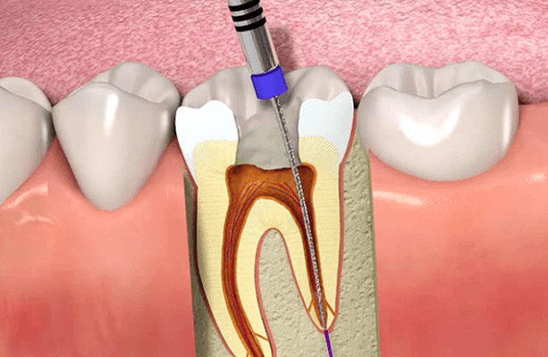 Root Canal Treatment in Gurugram Root Canal Treatment in Gurugram