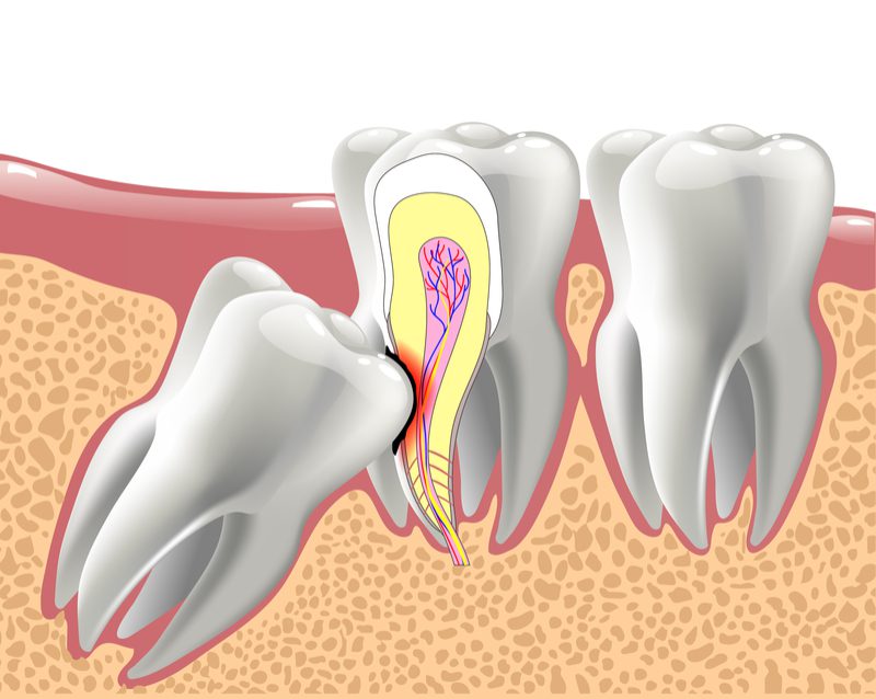 Root Canal Treatment in Gurugram Root Canal Treatment in Gurugram