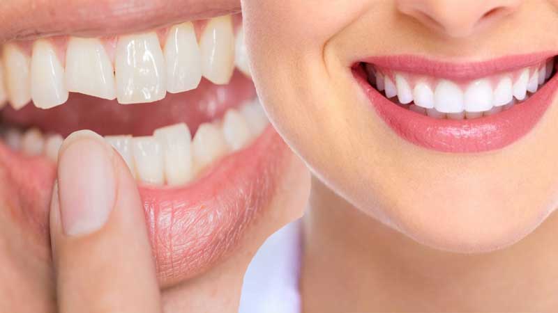 Root Canal Treatment in Gurugram Root Canal Treatment in Gurugram