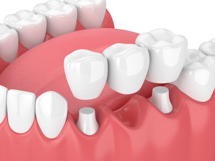 Root Canal Treatment in Gurugram Root Canal Treatment in Gurugram