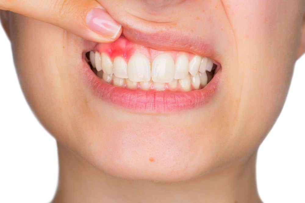 Root Canal Treatment in Gurugram Root Canal Treatment in Gurugram
