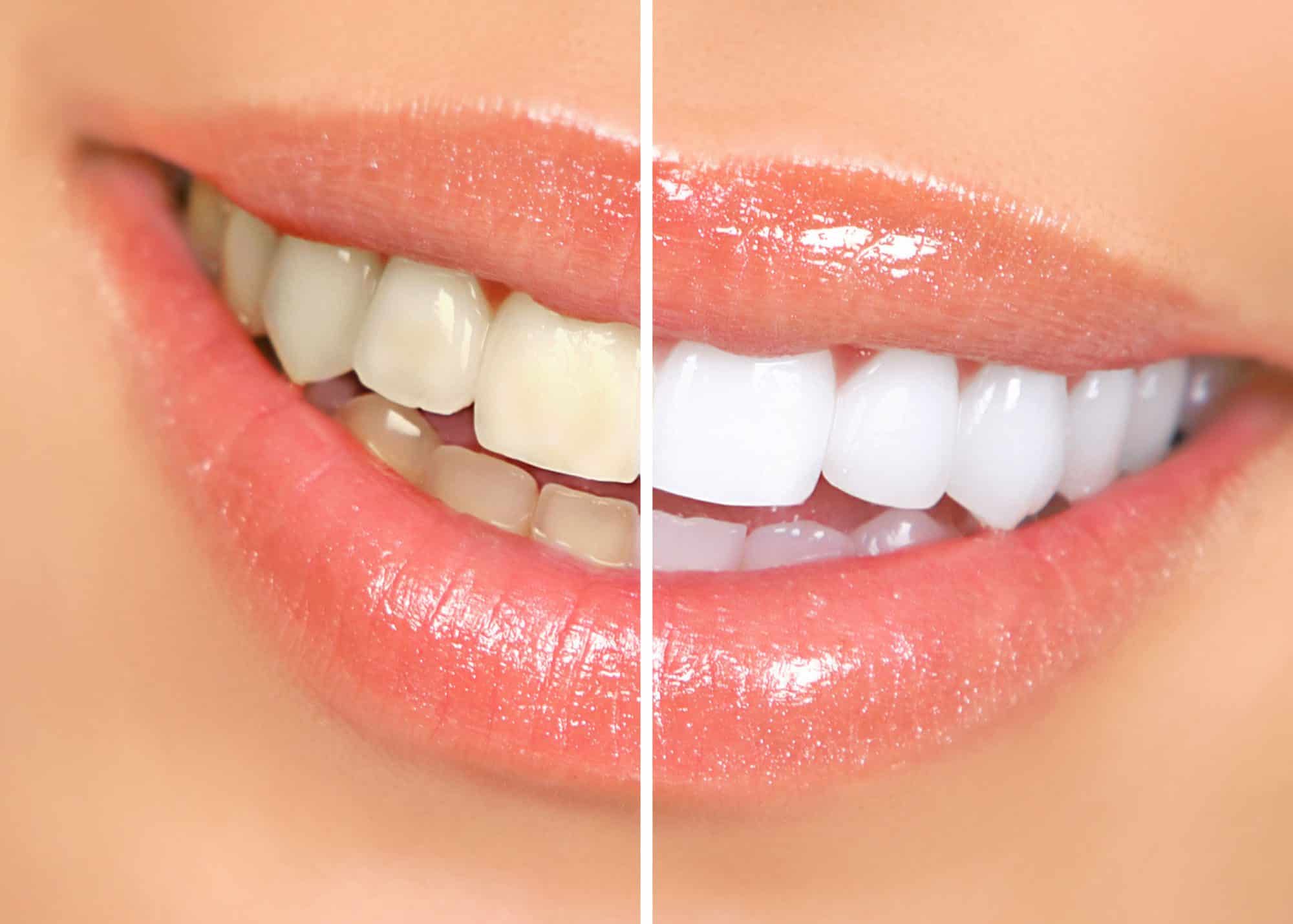 Root Canal Treatment in Gurugram Root Canal Treatment in Gurugram